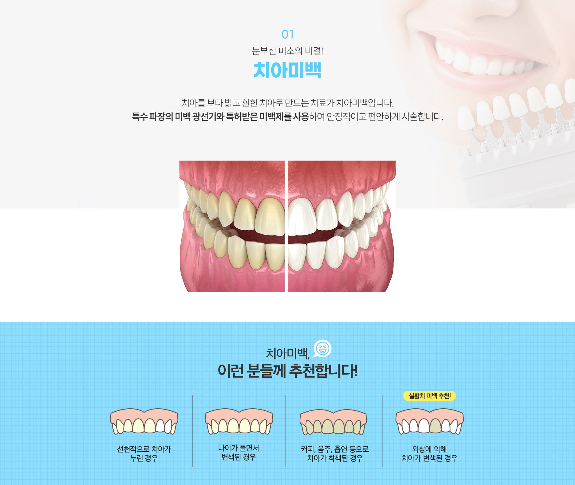 01.치아미백