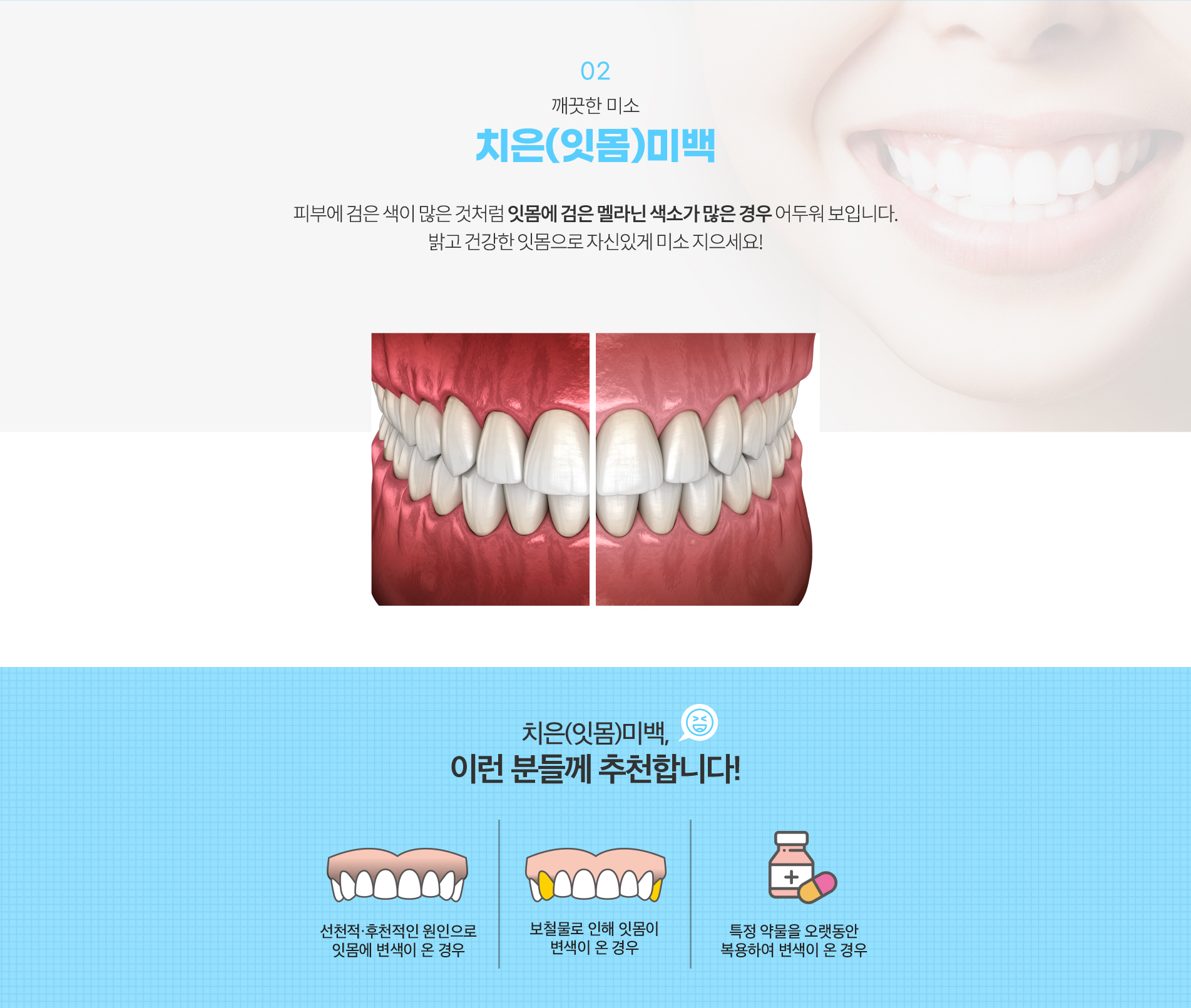 02.치은(잇몸)미백