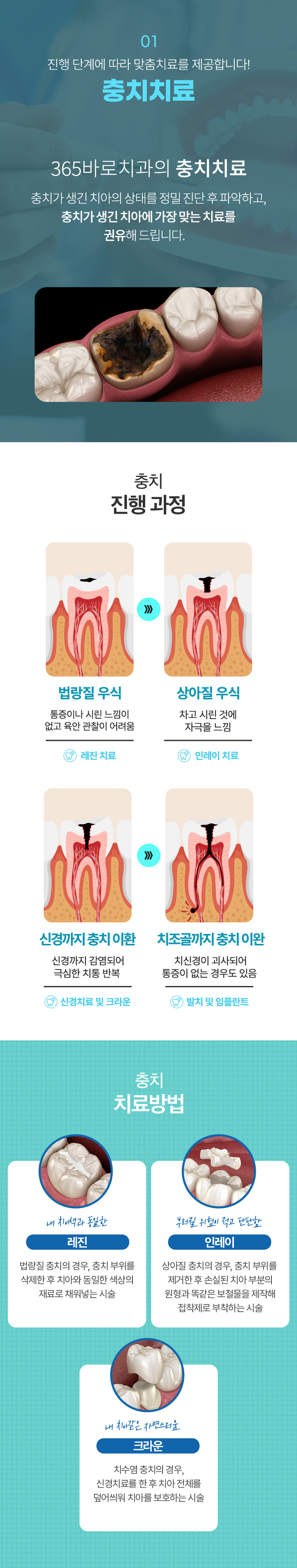 01.충치치료