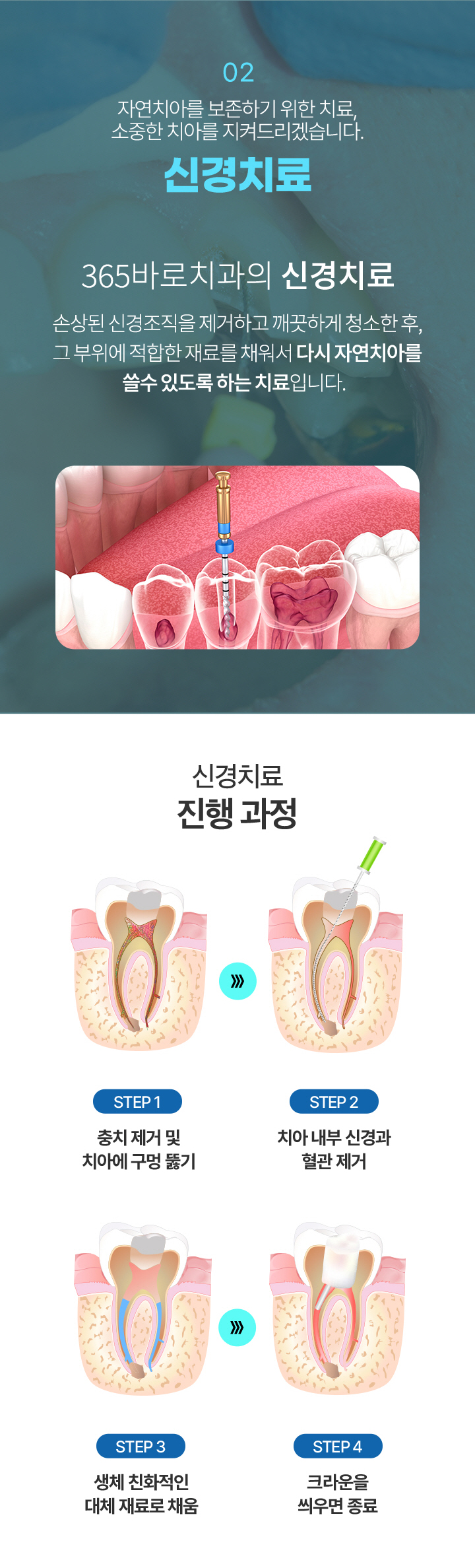 02.신경치료