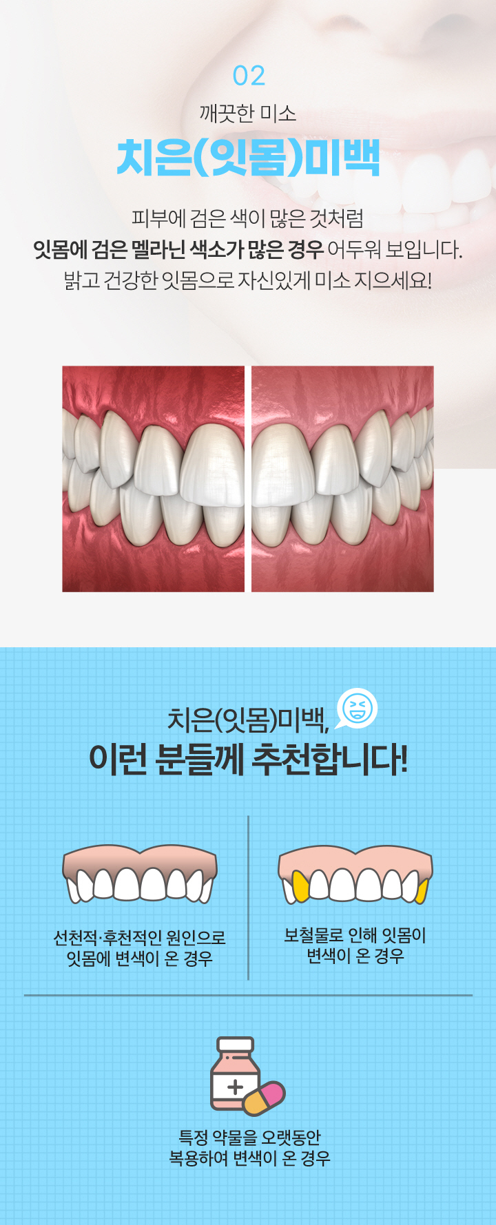 02.치은(잇몸)미백